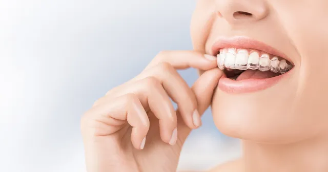 Invisalign