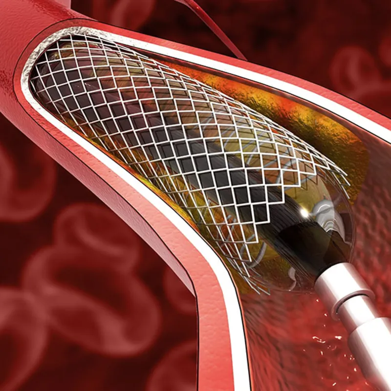 Coronary Artery Angiography (CAG) and Percutaneous Coronary Intervention (PCI)